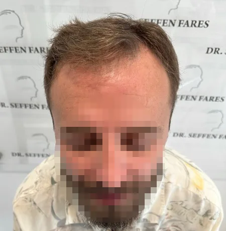 Patient 80, avant greffe de cheveux