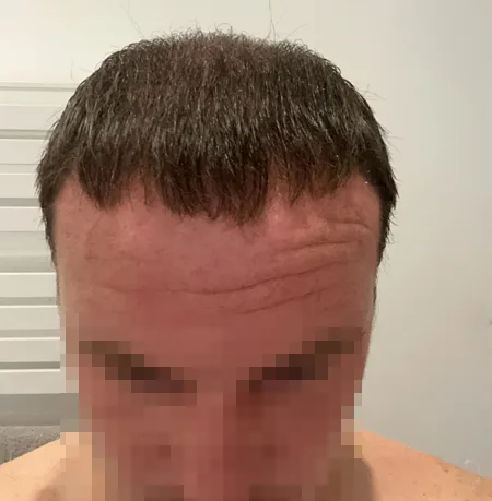 Patient 79, après greffe de cheveux