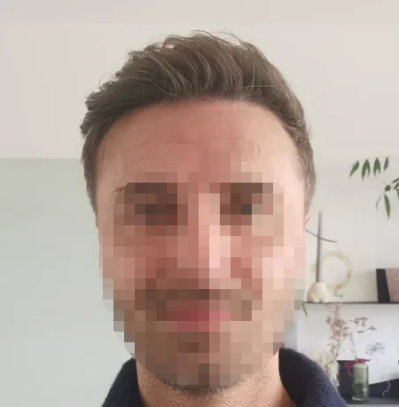 Patient 80, après greffe de cheveux