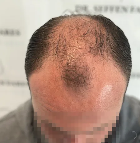 Patient 79, avant greffe de cheveux