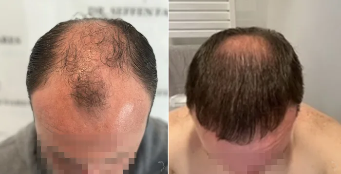 Patient 79, before and after hair transplant, view 1