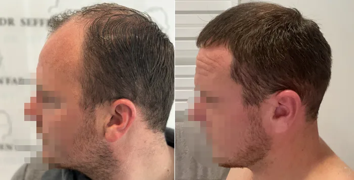 Patient 79, before and after hair transplant, view 3
