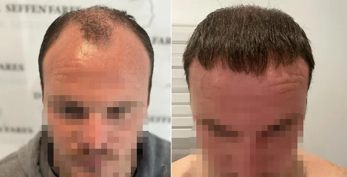 Patient 79, before and after hair transplant, view 2