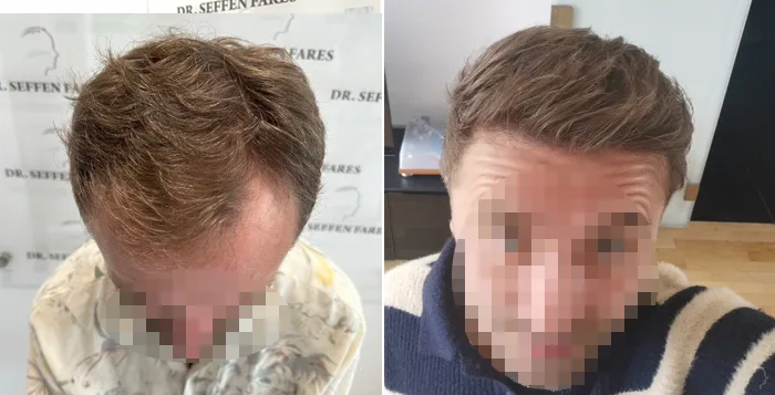 Patient 80, before and after hair transplant, view 2
