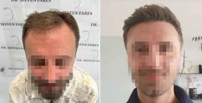 Patient 80, before and after hair transplant, view 1