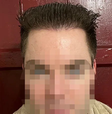 Patient 81 — 3,080 grafts · Norwood 3 · age 34, after hair transplant