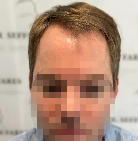 Patient 81 — 3,080 grafts · Norwood 3 · age 34, before hair transplant