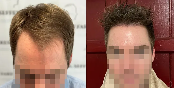 Patient 81, before and after hair transplant, view 5