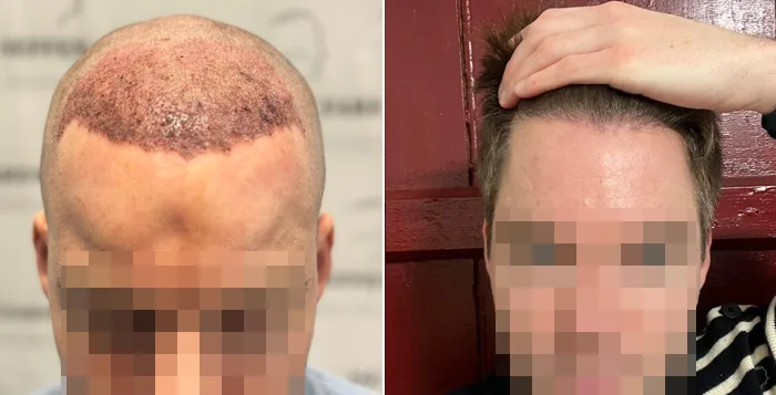 Patient 81, before and after hair transplant, view 6