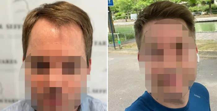 Patient 81, before and after hair transplant, view 1