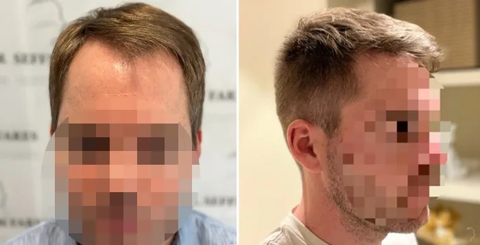 Patient 81, before and after hair transplant, view 2