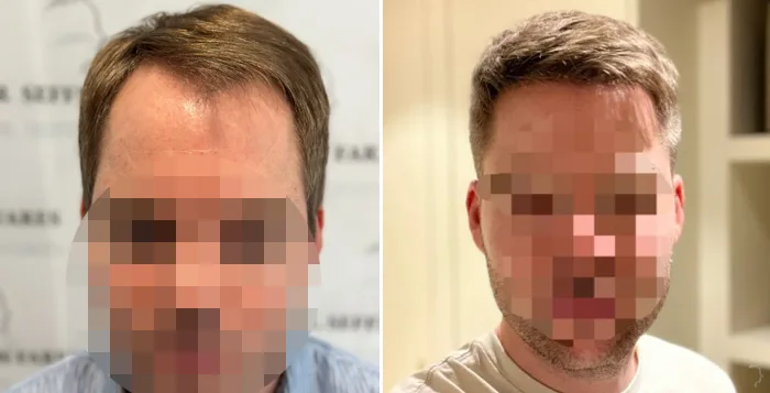 Patient 81, before and after hair transplant, view 3