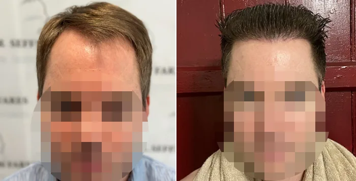 Patient 81, before and after hair transplant, view 4