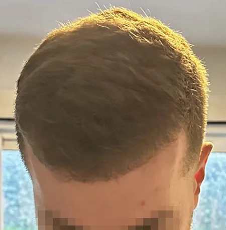Patient 82, après greffe de cheveux