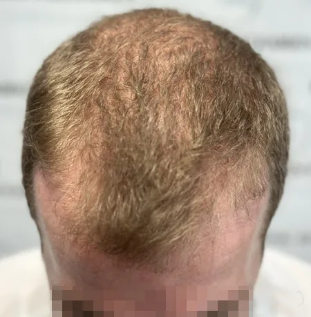 Patient 82, avant greffe de cheveux