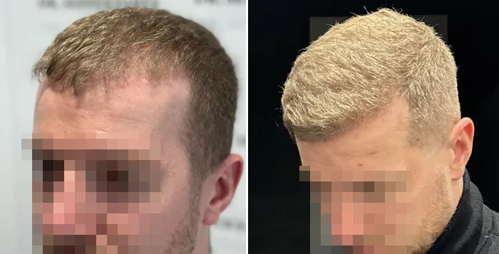 Patient 82, avant et après greffe de cheveux, vue 2