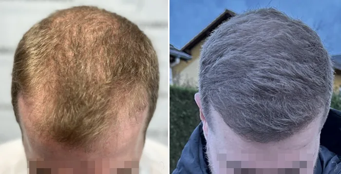 Patient 82, avant et après greffe de cheveux, vue 4