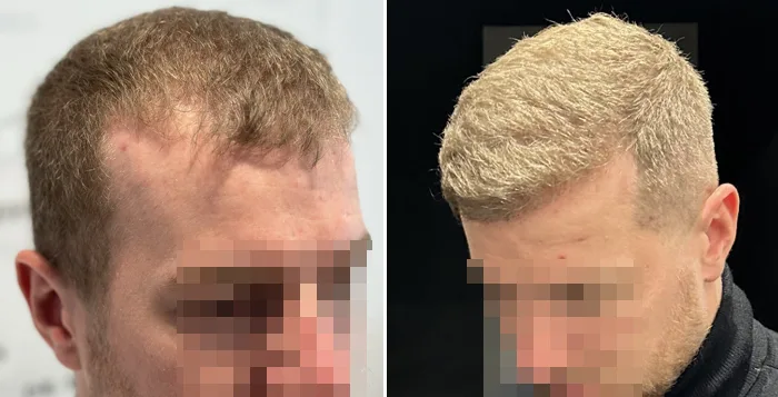 Patient 82, before and after hair transplant, view 3
