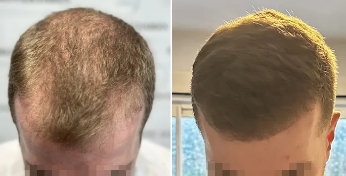 Patient 82, avant et après greffe de cheveux, vue 1