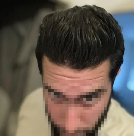 Patient 83 — 3,760 grafts · Norwood 4 E · age 33, after hair transplant