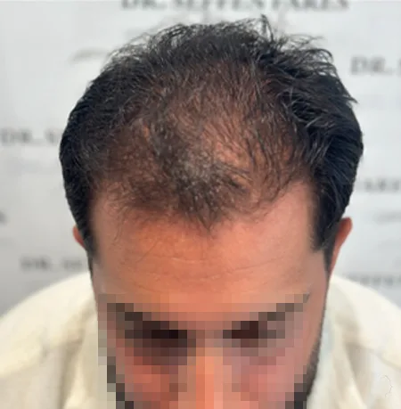 Patient 83 — 3,760 grafts · Norwood 4 E · age 33, before hair transplant