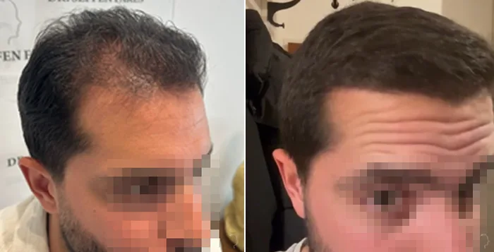 Patient 83, before and after hair transplant, view 3
