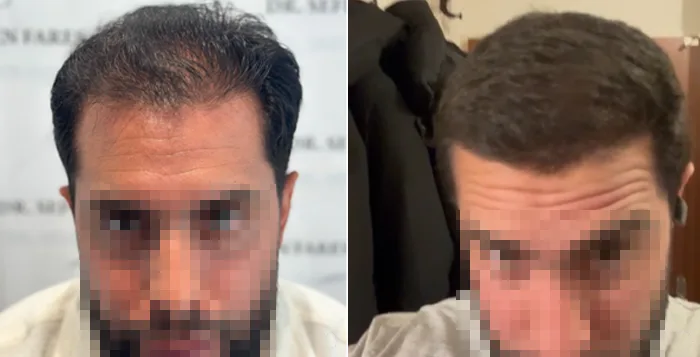 Patient 83, before and after hair transplant, view 2