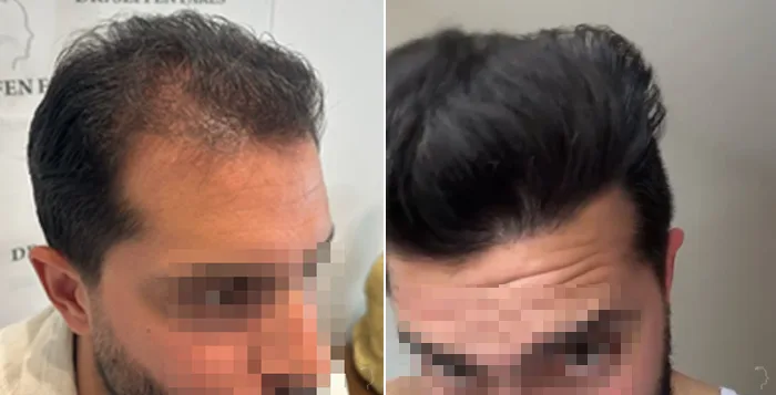 Patient 83, before and after hair transplant, view 4