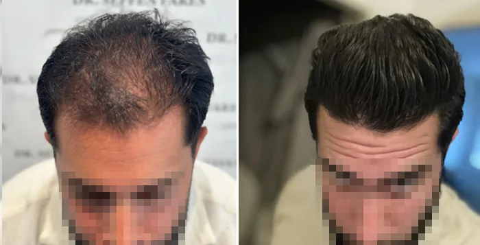 Patient 83, before and after hair transplant, view 1