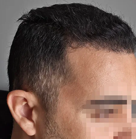 Patient 84, après greffe de cheveux