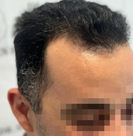 Patient 84, avant greffe de cheveux