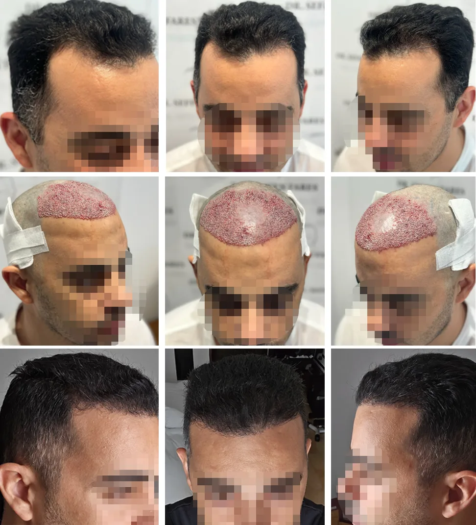 Patient 84, before and after hair transplant, view 1