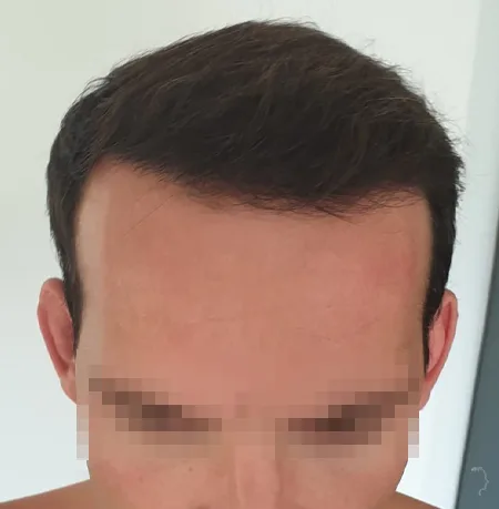 Patient 85, après greffe de cheveux