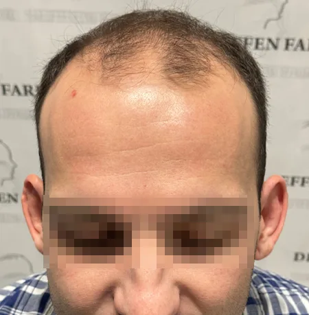 Patient 85, avant greffe de cheveux