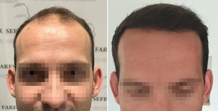 Patient 85, before and after hair transplant, view 3