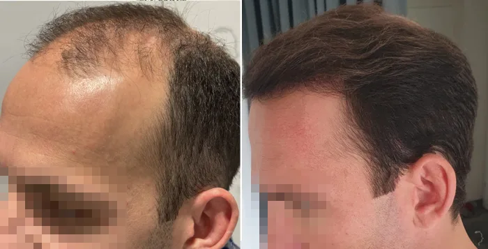 Patient 85, before and after hair transplant, view 5