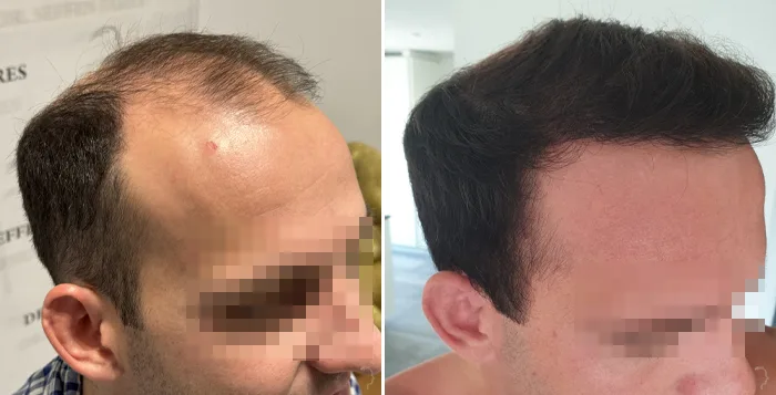 Patient 85, before and after hair transplant, view 4