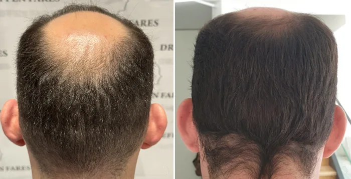 Patient 85, before and after hair transplant, view 6