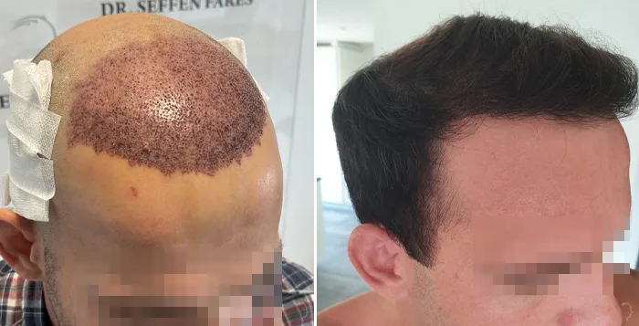 Patient 85, before and after hair transplant, view 1