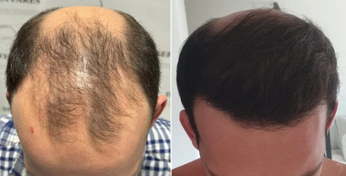 Patient 85, before and after hair transplant, view 2