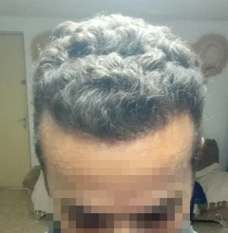 Patient 86 — 3,124 grafts · Norwood 3 · age 35, after hair transplant