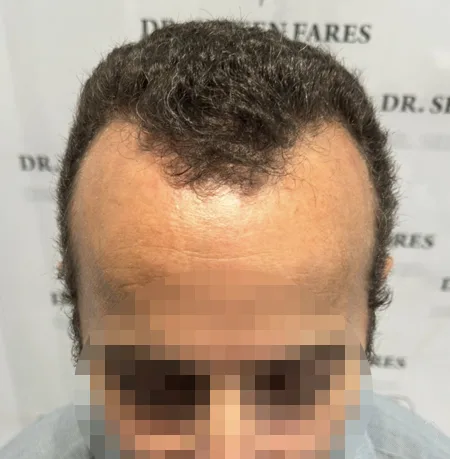 Patient 86, avant greffe de cheveux