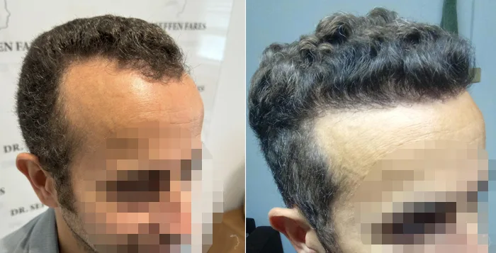Patient 86, before and after hair transplant, view 2