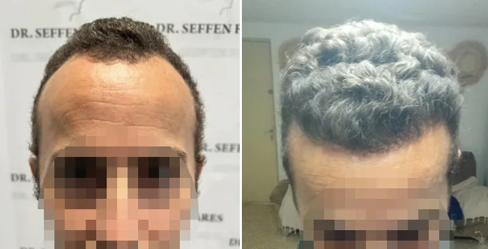 Patient 86, before and after hair transplant, view 3