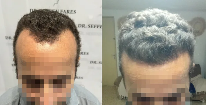 Patient 86, before and after hair transplant, view 1
