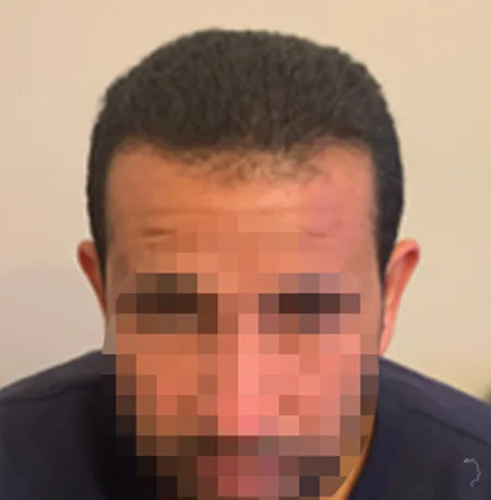 Patient 87 — 4,088 grafts · Norwood 6 · age 40, after hair transplant