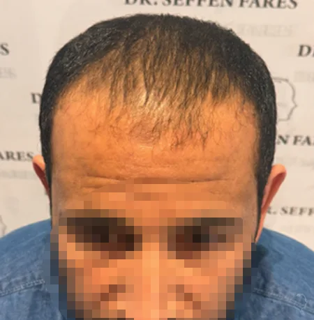 Patient 87 — 4,088 grafts · Norwood 6 · age 40, before hair transplant