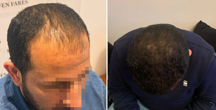 Patient 87, before and after hair transplant, view 2