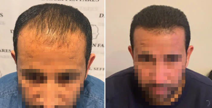Patient 87, before and after hair transplant, view 1