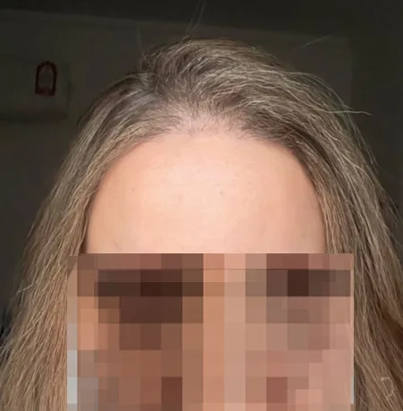 Patient 88 — 2,343 grafts · age 29, after hair transplant